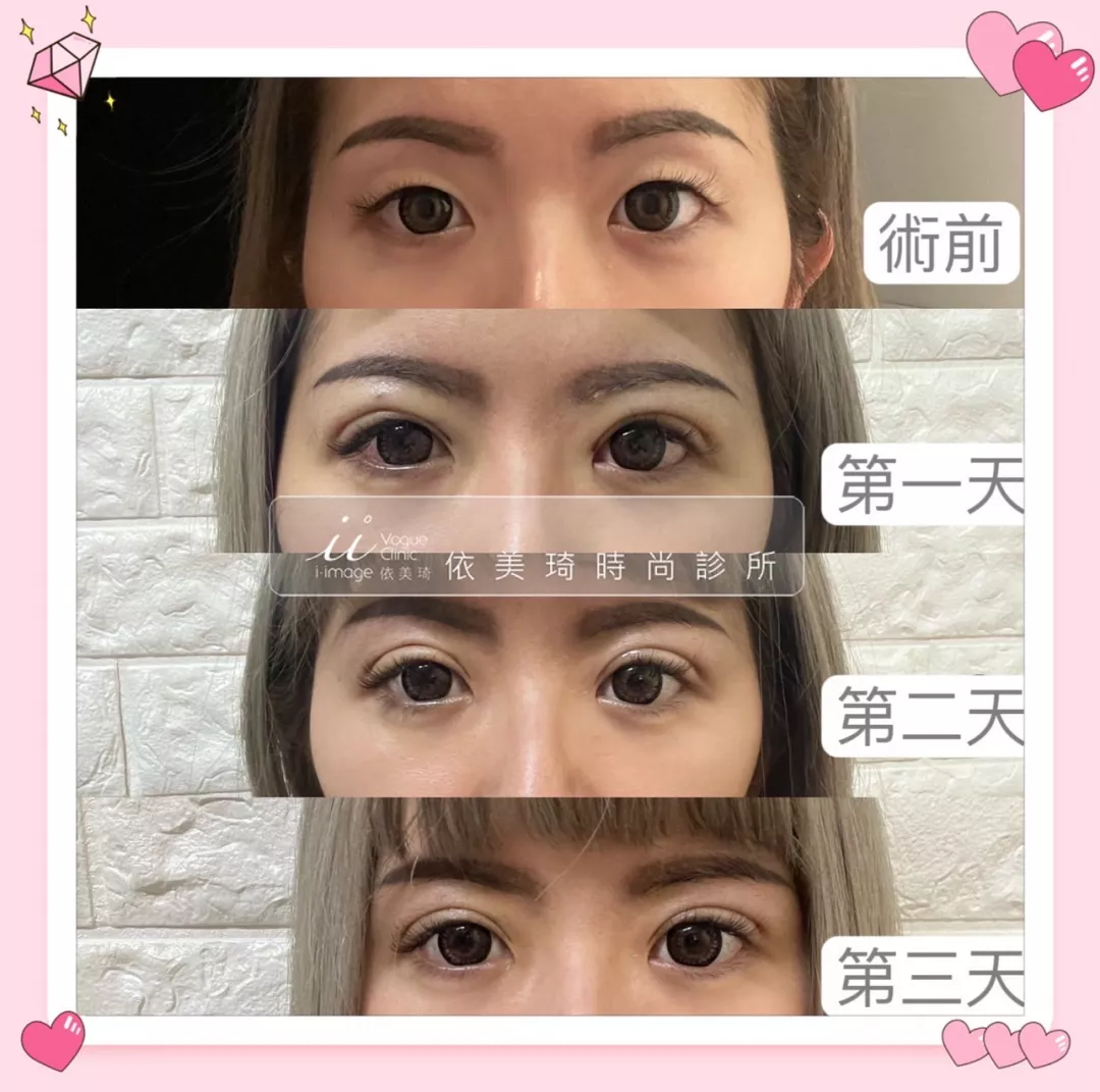 QQ無痕雙眼皮恢復期