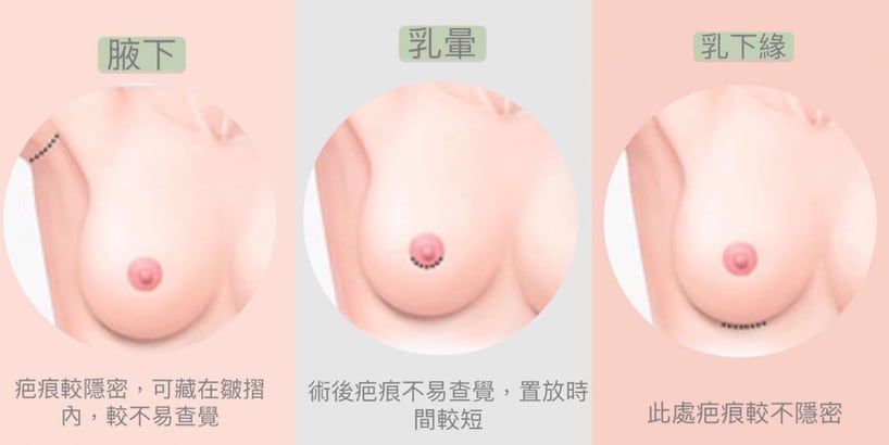 常見隆乳手術切口位置