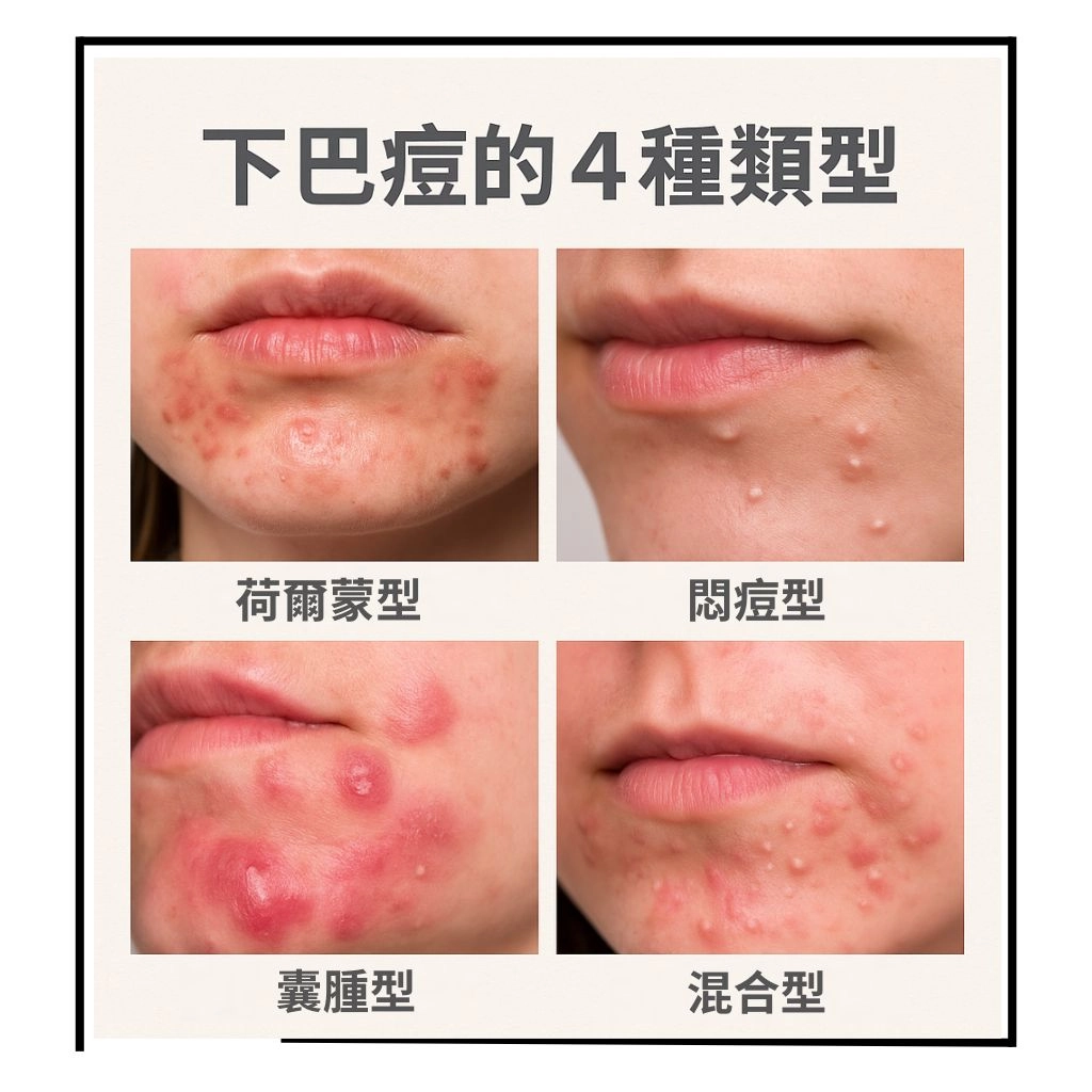 下巴長痘痘原因