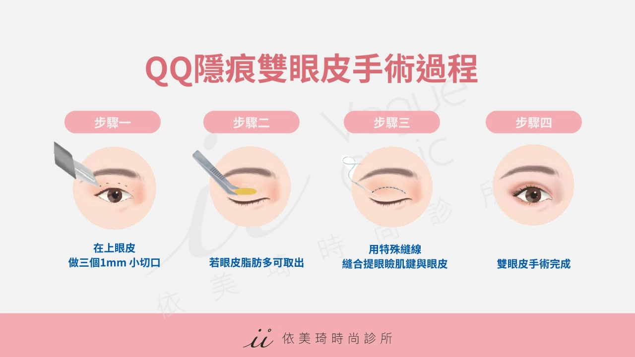 QQ隱痕雙眼皮手術過程