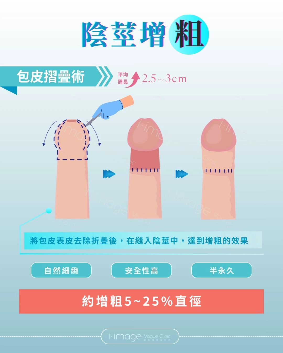 陰莖增粗-包皮摺疊術