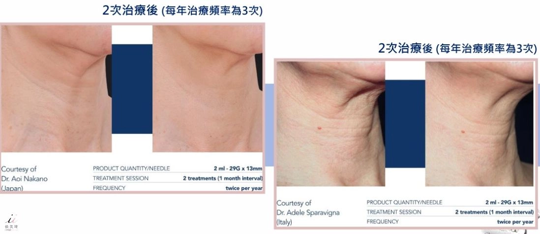 Profhilo 逆時針實際案例