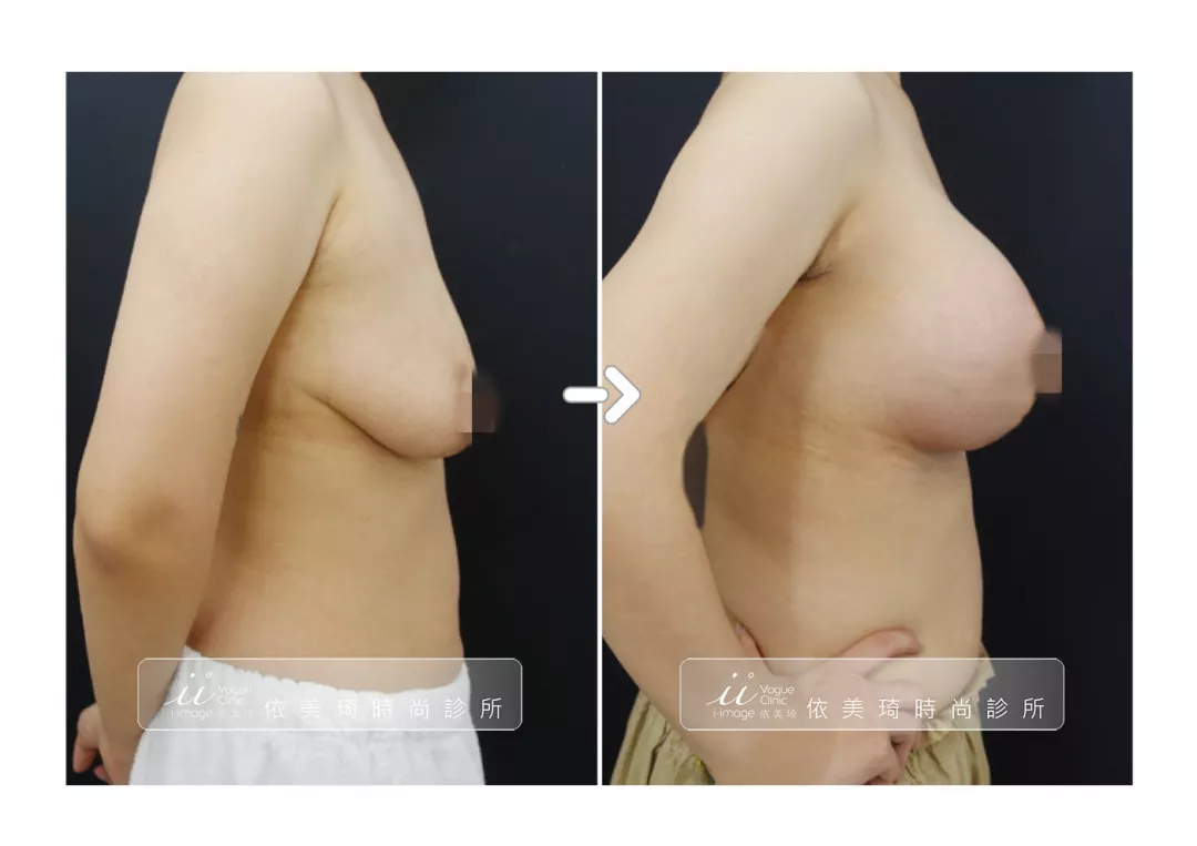 隆乳＋提乳手術案例照（側面）