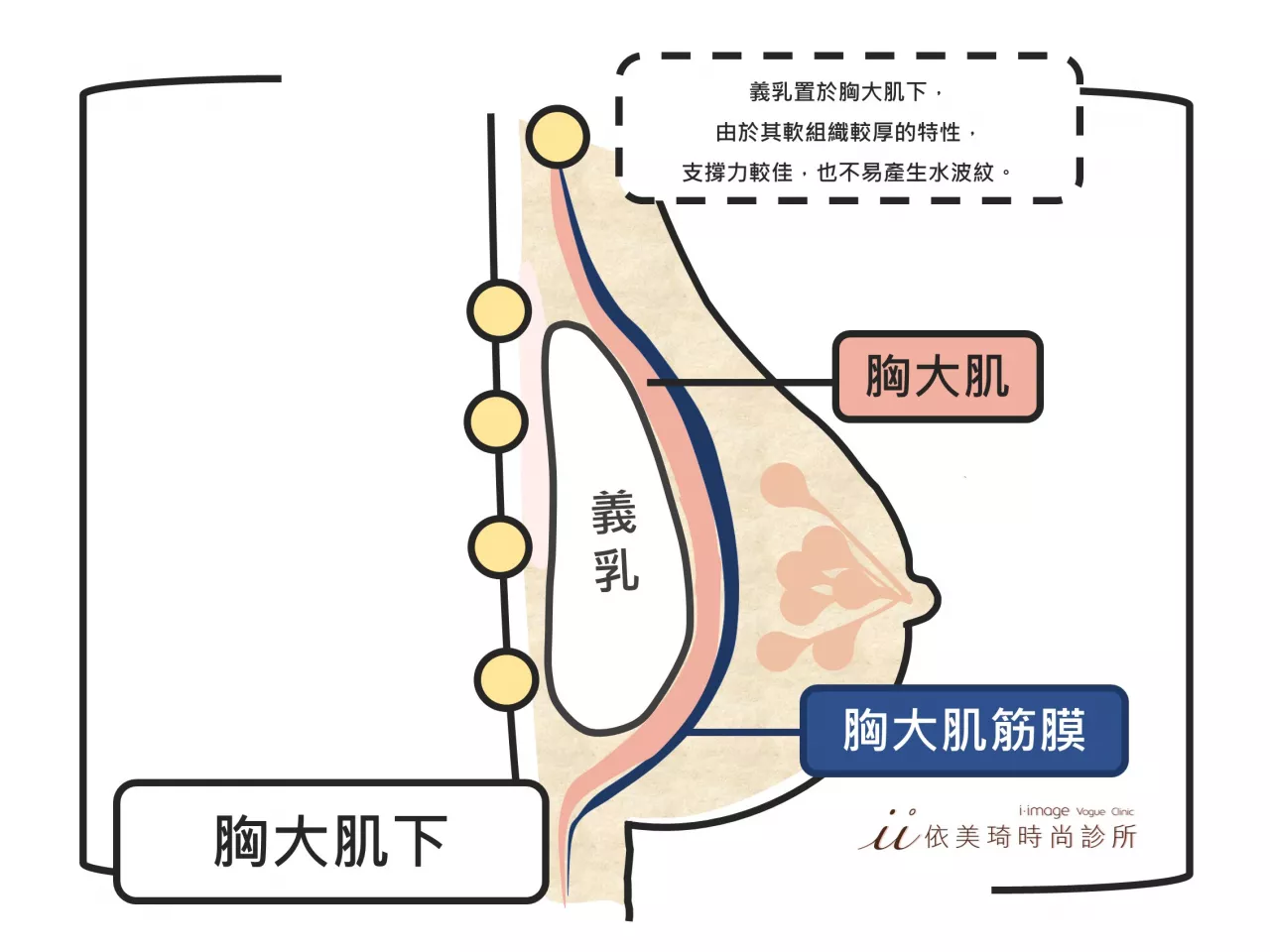 隆乳假體放置胸大肌下位置|隆乳手術多少錢？｜隆乳手術危險嗎？｜隆乳手術前注意事項｜隆乳術後照顧｜隆乳手術過程