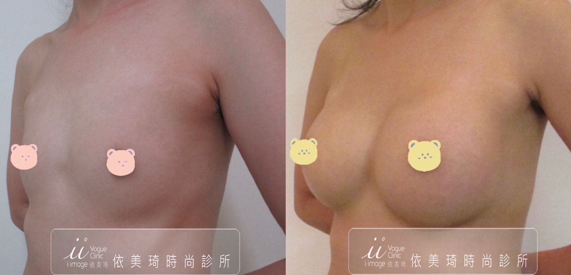 絨毛水滴果凍矽膠隆乳～～中凸315cc 45度角