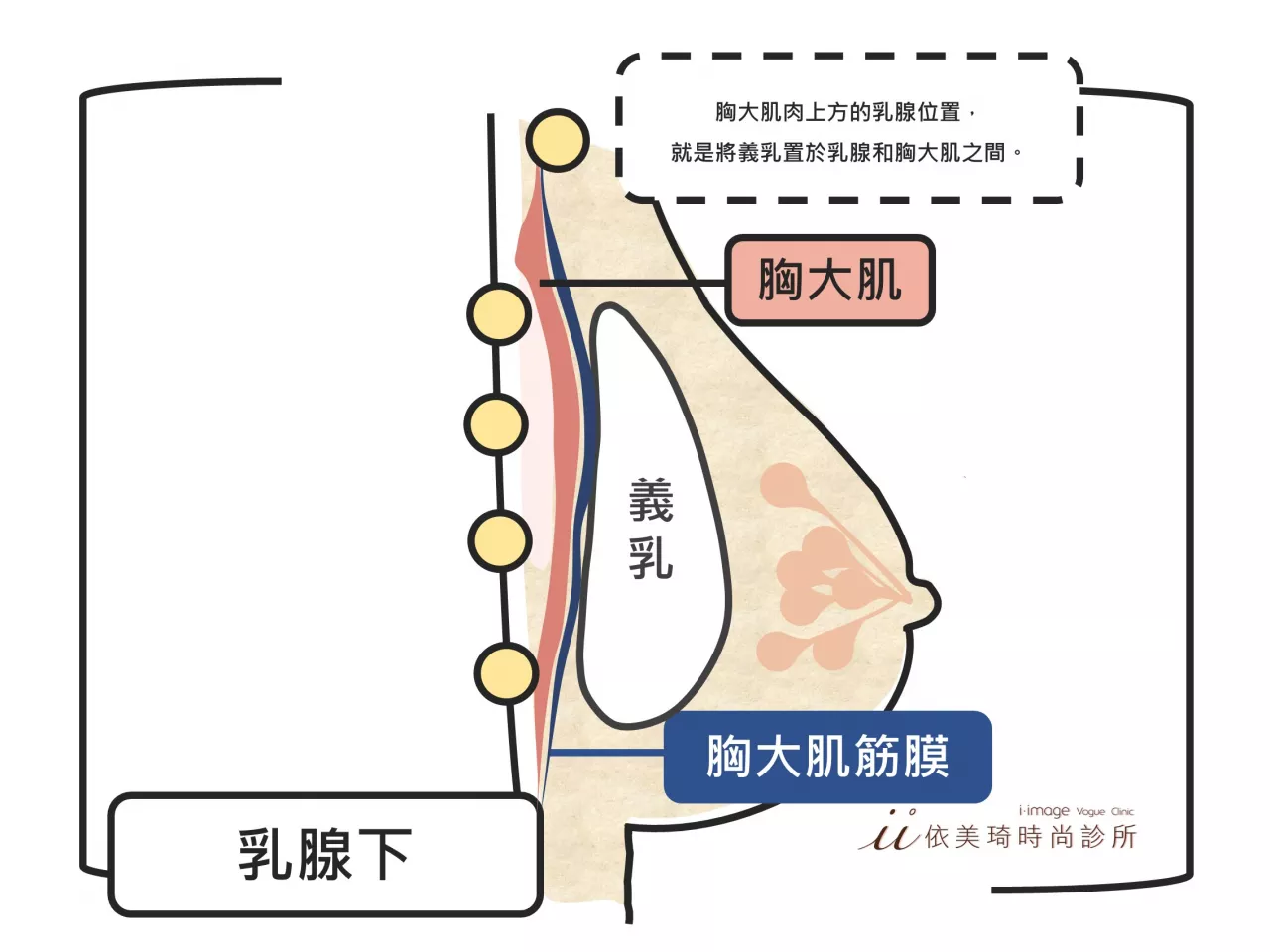 隆乳假體放置乳腺下位置|隆乳手術多少錢？｜隆乳手術危險嗎？｜隆乳手術前注意事項｜隆乳術後照顧｜隆乳手術過程