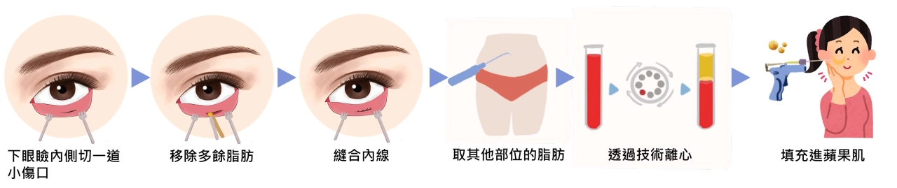 內開 + 蘋果肌補脂過程