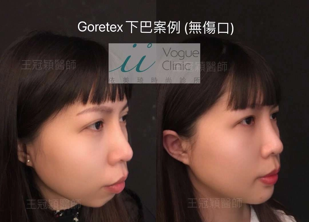 墊下巴手術達到臉型精緻