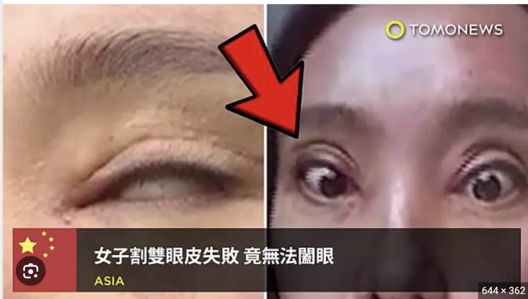 割雙眼皮風險