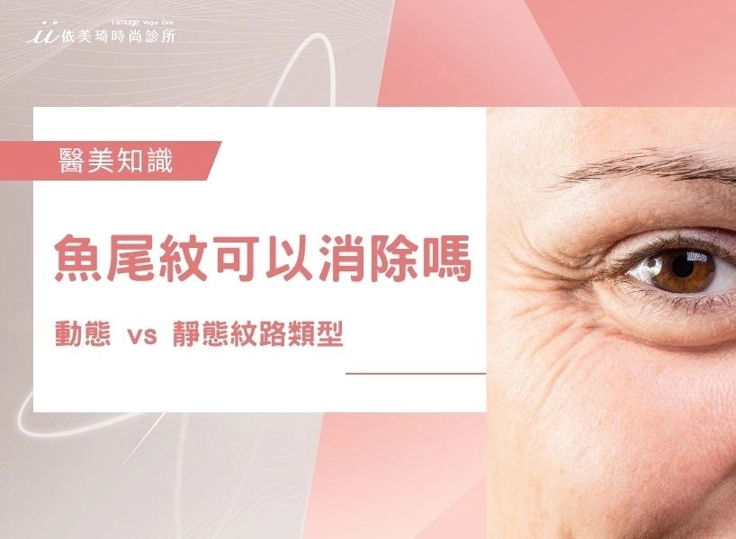魚尾紋可以消除嗎？動態 vs 靜態紋路類型、成因、療程一次看！