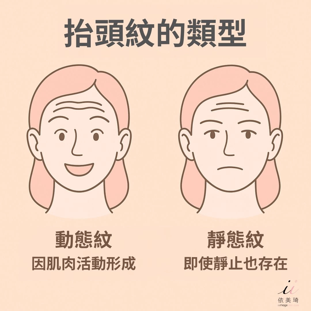抬頭紋種類