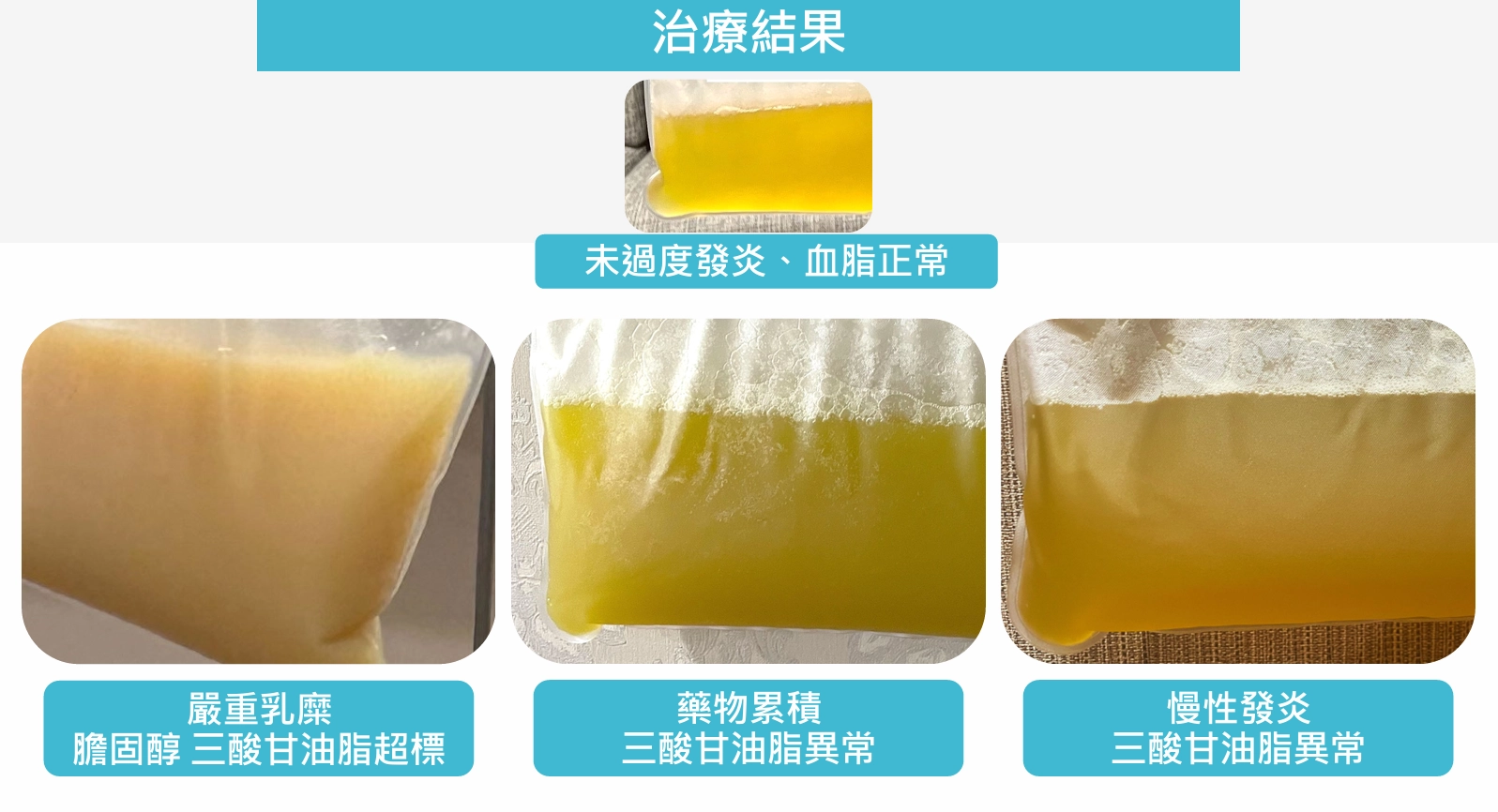 MCS+血漿置換術真實術後反饋