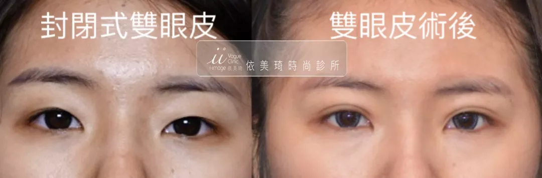 封閉式雙眼皮
