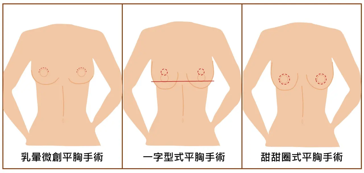 平胸手術方式|一字型平胸手術|乳暈微創平胸手術|甜甜圈式平胸手術