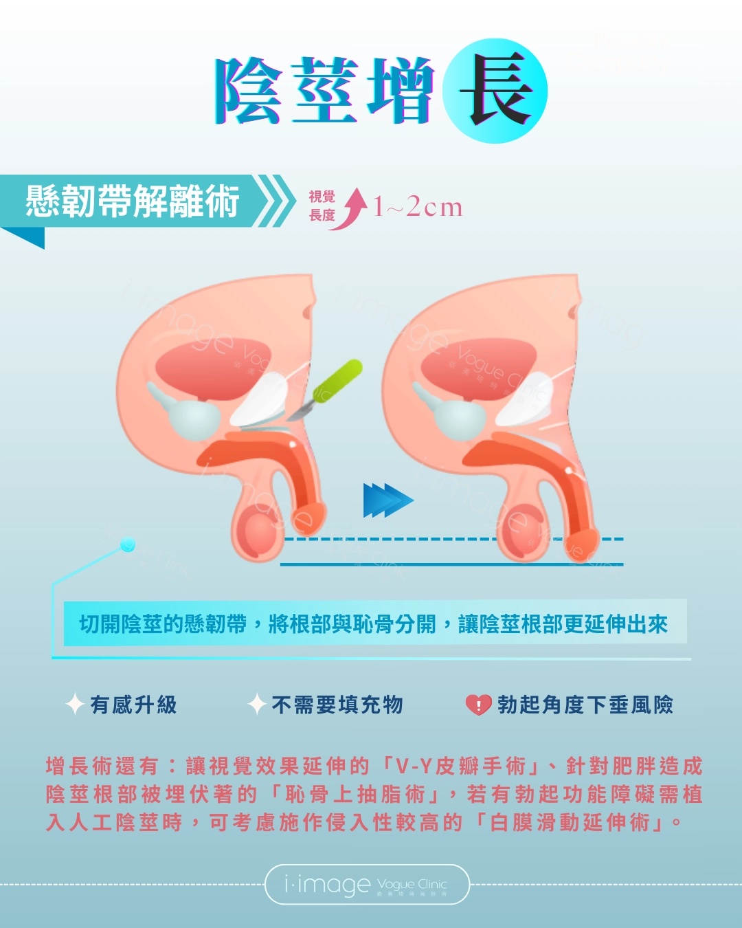 陰莖增長：懸韌帶解離術