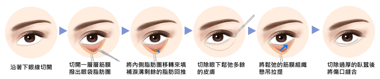 複合式隱痕眼袋拉提手術過程