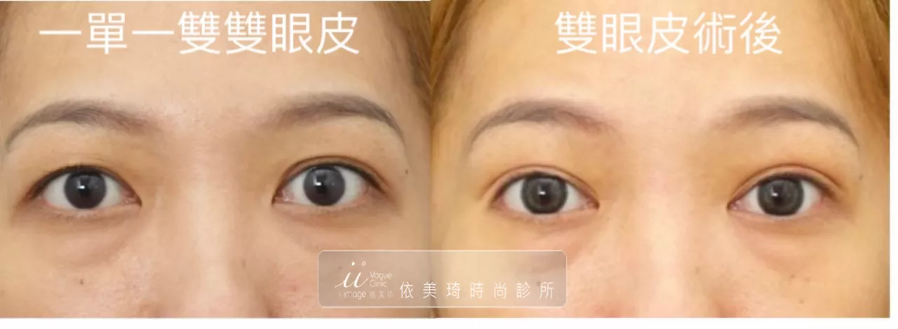 一單一雙眼皮