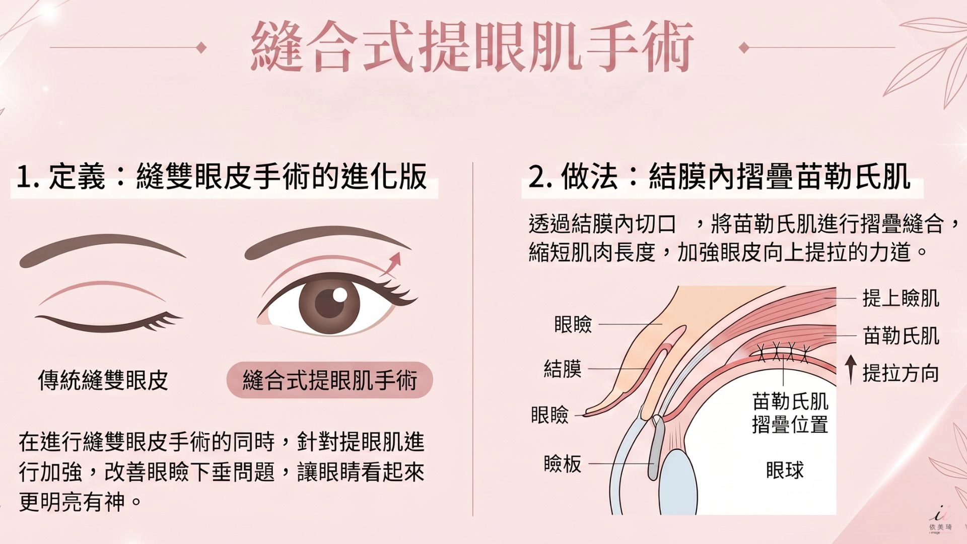 縫合式提眼肌手術｜輕度無力首選，縫合式是縫雙眼皮手術的進化版，在縫雙眼皮的同時，透過結膜內摺疊苗勒氏肌（ Müller's Muscle ），加強眼皮向上提拉的力道。