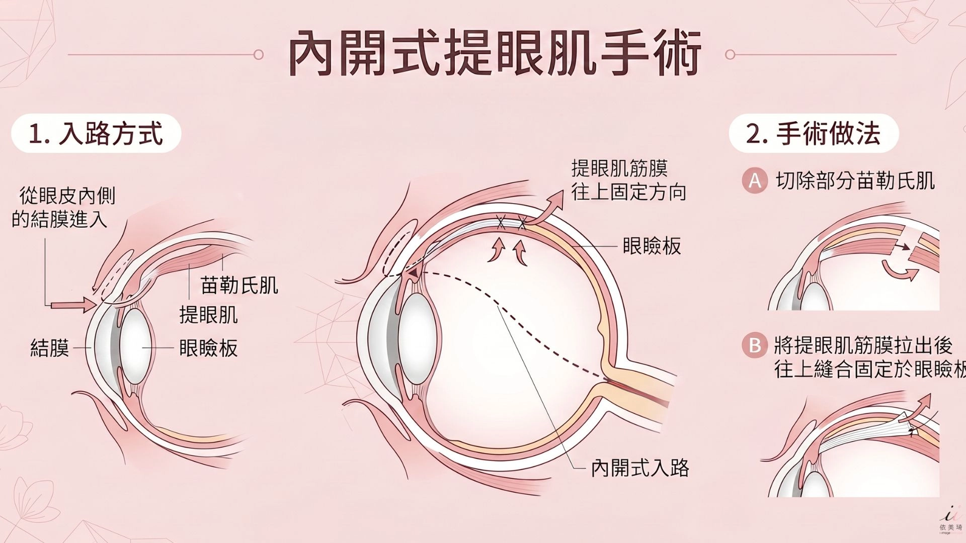 內開式提眼肌手術｜輕至中度、不想留外疤，從眼皮內側的結膜進入，切除部分苗勒氏肌，或將提眼肌筋膜拉出後往上縫合固定於眼瞼板。  因為入路在眼皮內側，外表完全看不到傷口。