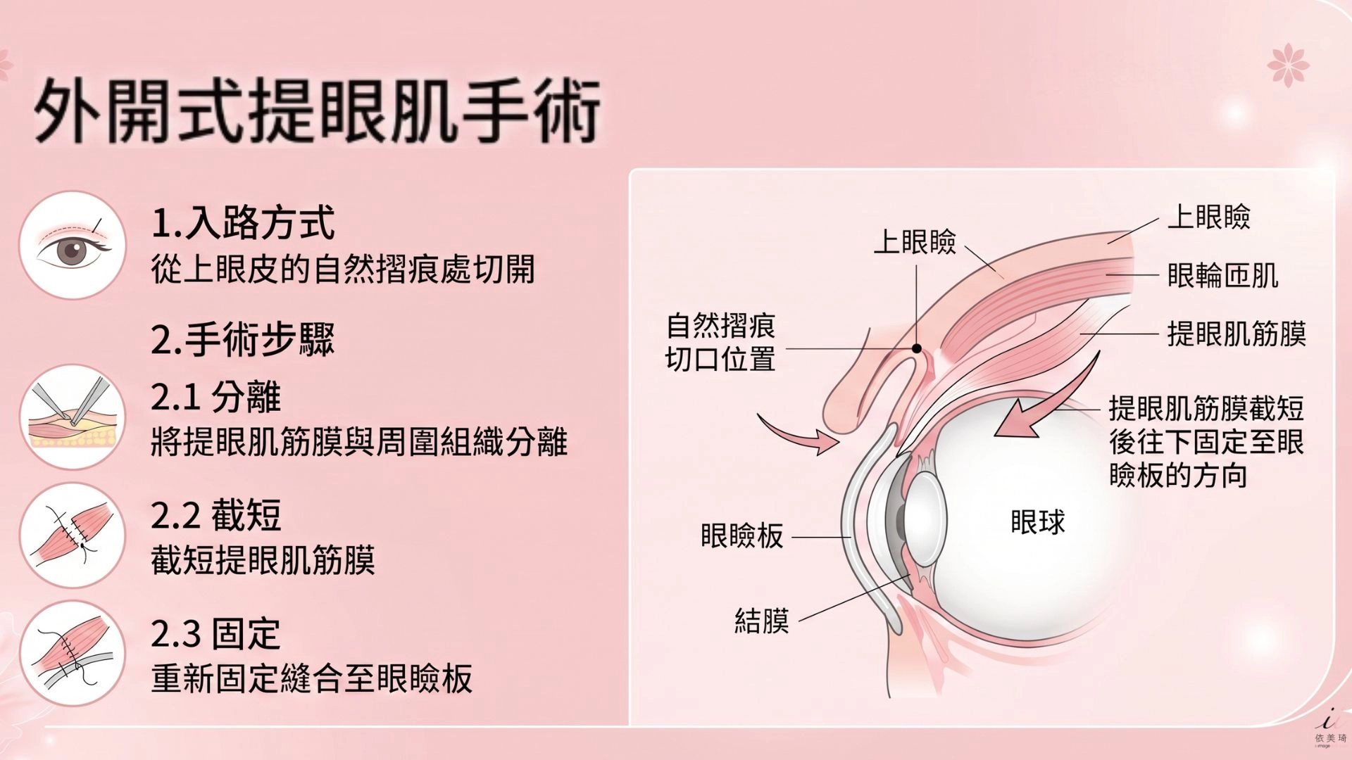 外開式提眼肌手術｜中至重度、效果最全面，從上眼皮的自然摺痕處切開，將提眼肌筋膜與周圍組織分離後截短，再重新固定縫合至眼瞼板。