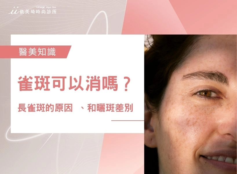 雀斑可以消嗎？先搞懂長雀斑的原因 、和曬斑差別，再看怎麼消除雀斑