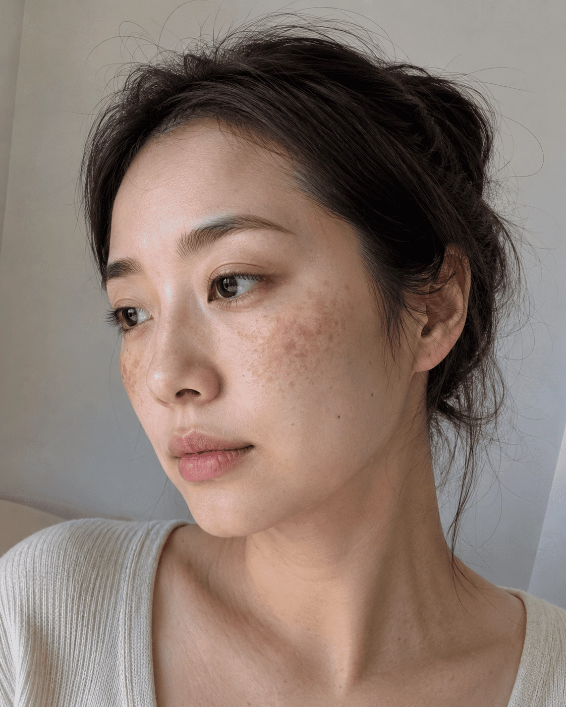 肝斑 （ Melasma，學名黃褐斑 ） 是一種以雙頰、額頭、上唇對稱性出現褐色至灰褐色斑塊的色素性皮膚疾病。
