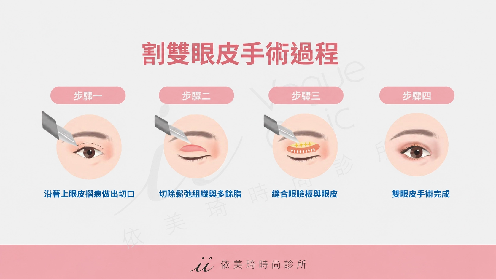 割雙眼皮是先將眼部脂肪取出，再將眼皮跟眼臉板縫合。