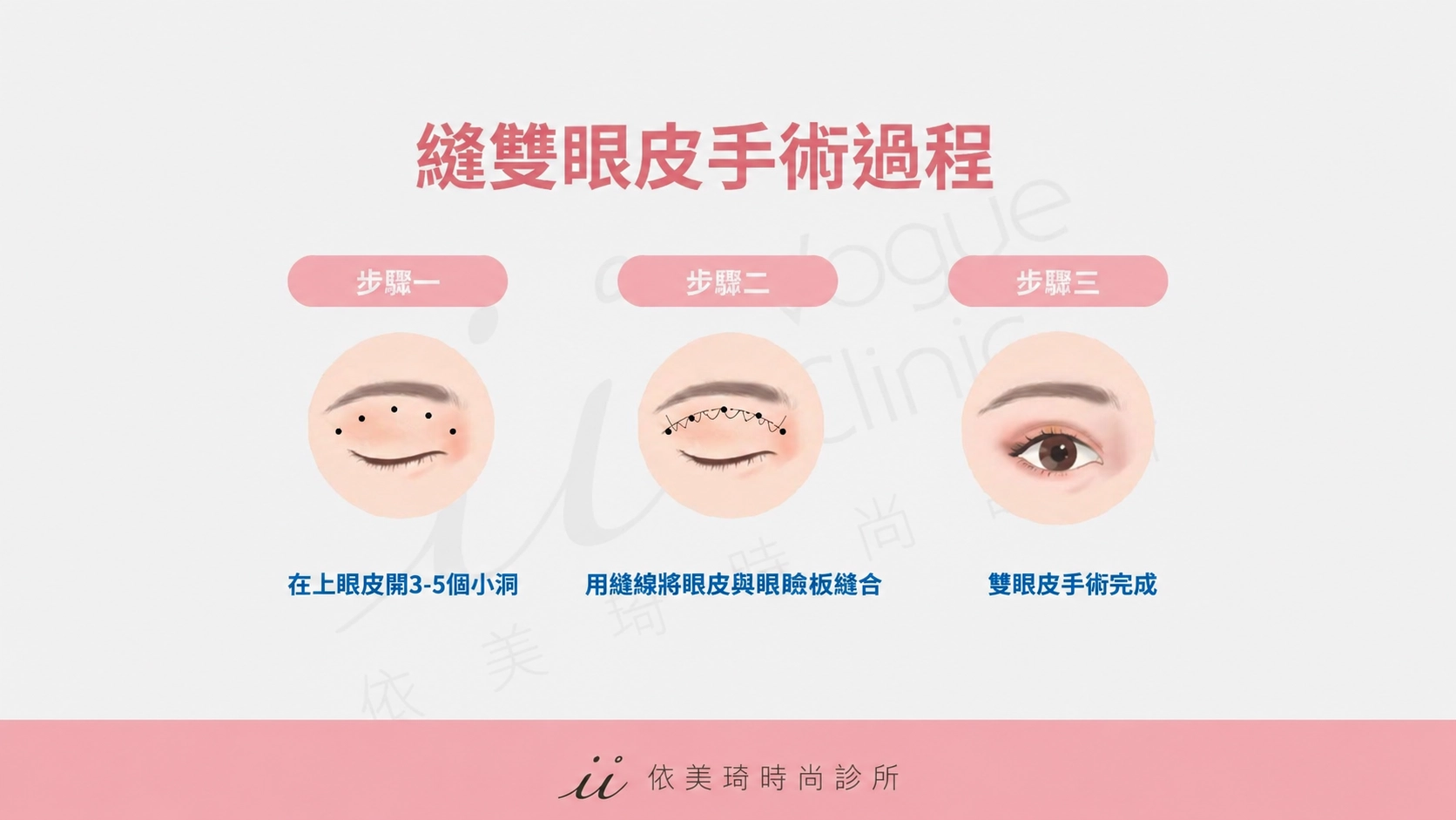 縫雙眼皮是採用在眼部進行縫合的方式，讓眼睛呈現出自然的雙眼皮摺痕。