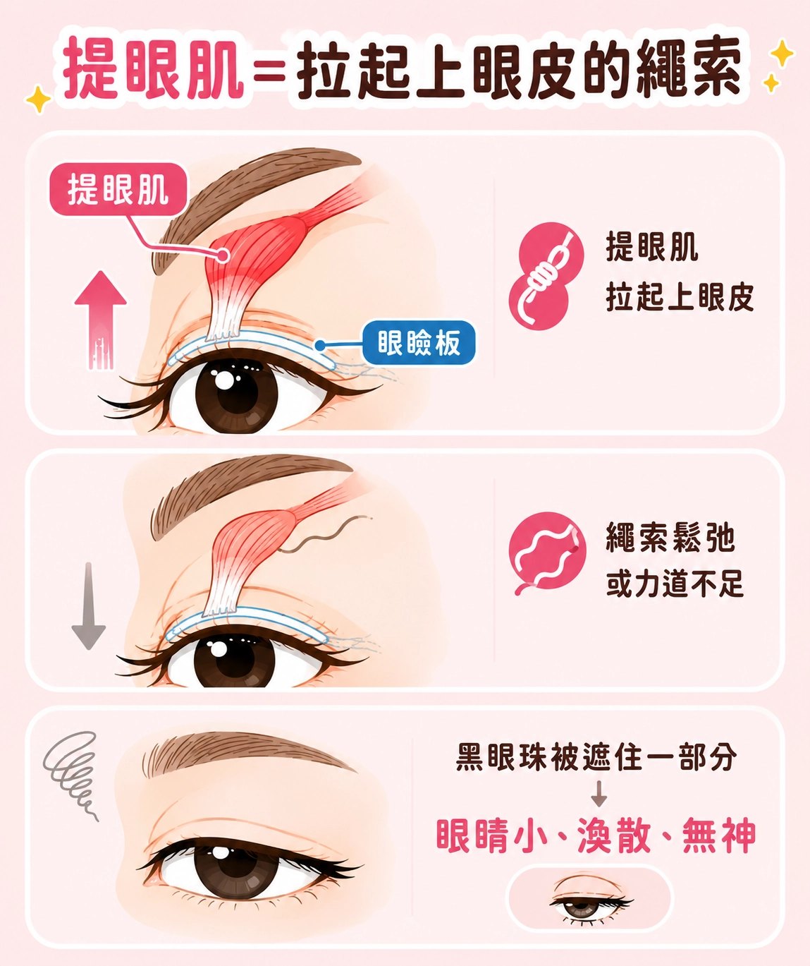 提眼肌無力：眼皮「抬不上去」