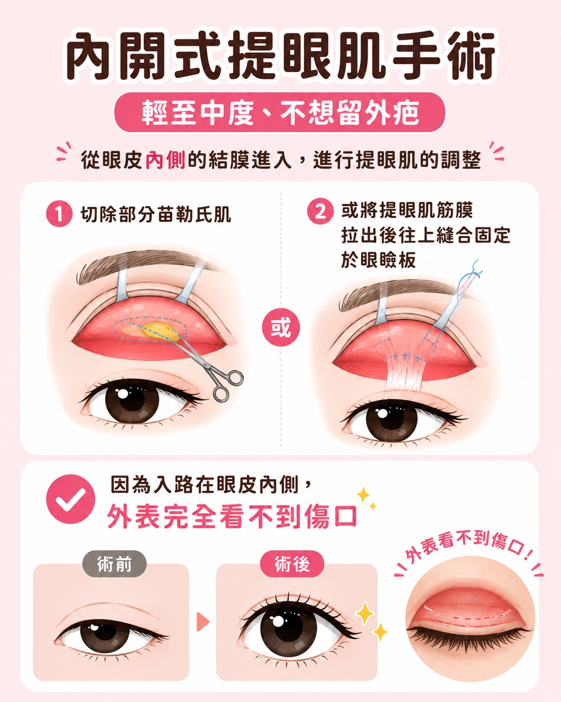 內開式提眼肌手術｜輕至中度、不想留外疤