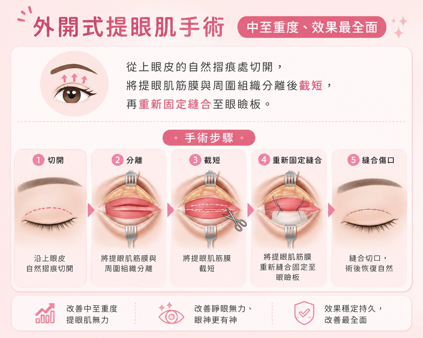 外開式提眼肌手術｜中至重度、效果最全面