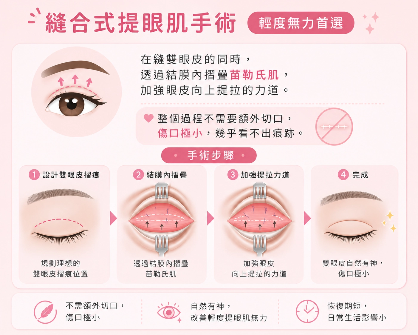 縫合式提眼肌手術｜輕度無力首選