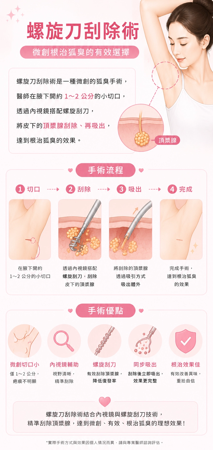 螺旋刀刮除術是一種微創的狐臭手術，醫師在腋下開約 1～2 公分的小切口，透過內視鏡搭配螺旋刮刀，將皮下的頂漿腺刮除、再吸出，達到根治狐臭的效果，傷口比傳統手術小、恢復也較快。