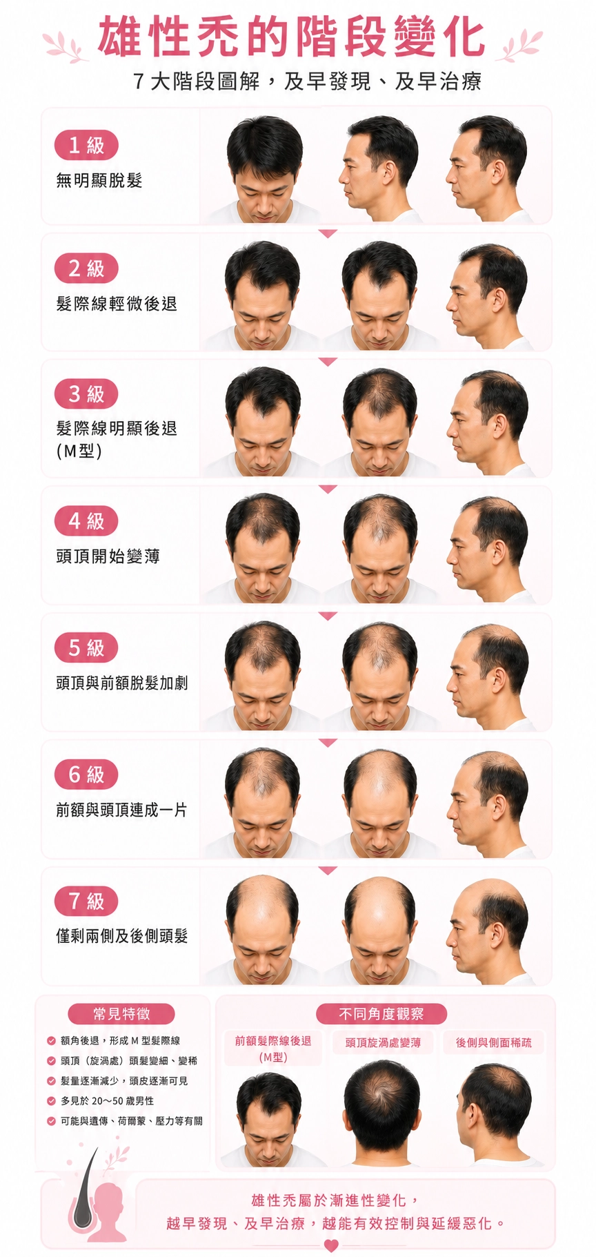 男性雄性禿依落髮嚴重程度，國際上以「 Norwood 分類」分成 1 到 7 期，數字愈大代表毛囊萎縮範圍愈廣。了解自己是哪期，是決定該用哪種療程的第一步！