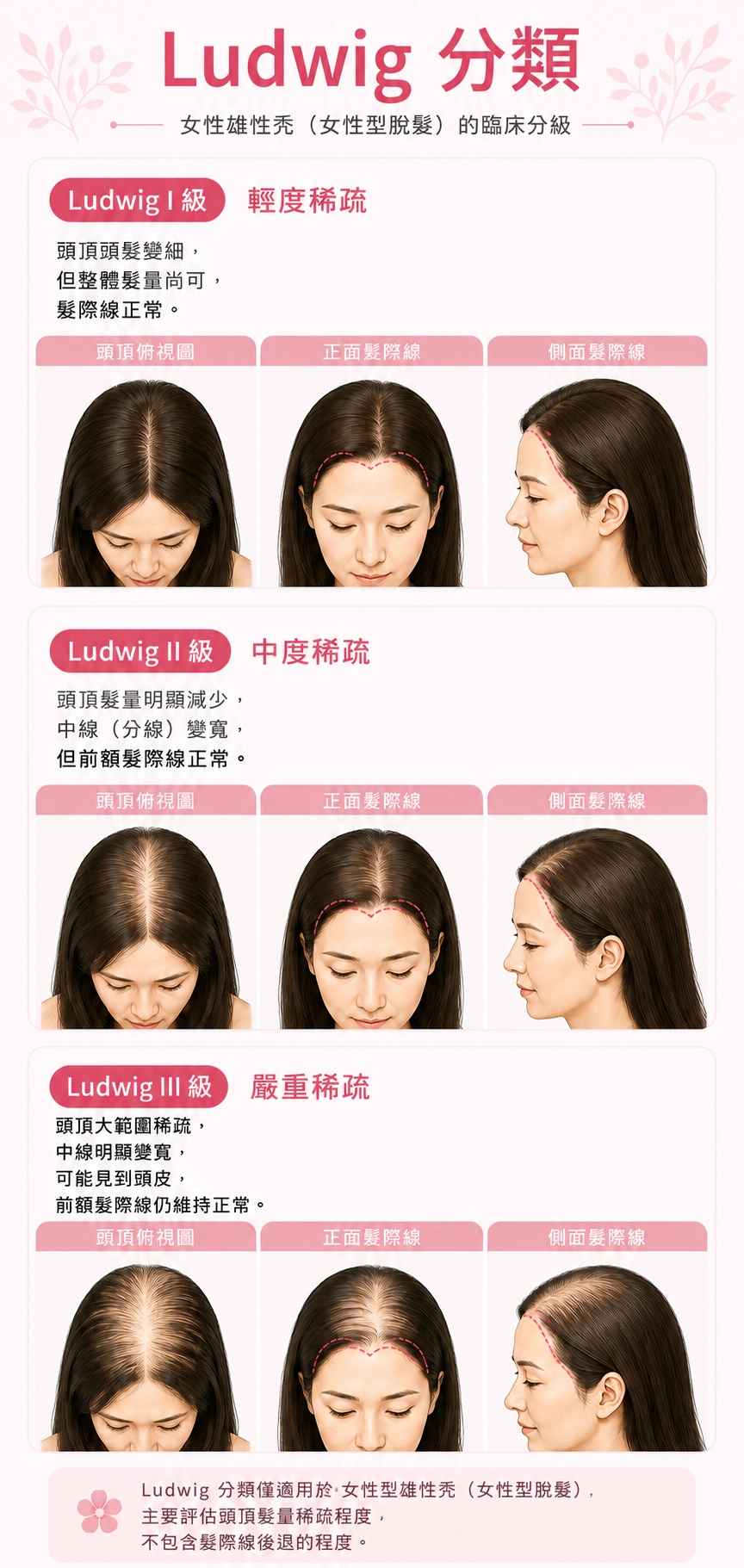 女性雄性禿常以 「 Ludwig 分類 」 分成 1～3 級，主要看頭頂稀疏程度。發生時間也比男性晚，多在 30 歲後出現，並可能因產後、更年期、停用避孕藥或荷爾蒙變化而惡化。