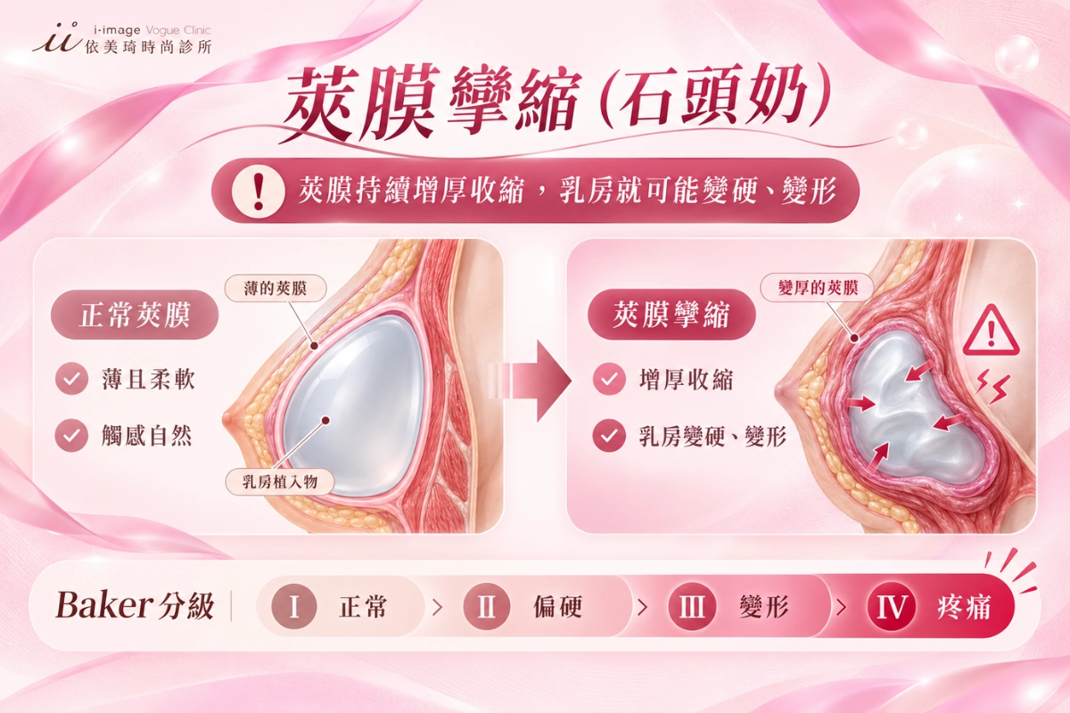 假體隆乳後遺症：莢膜攣縮（石頭奶）