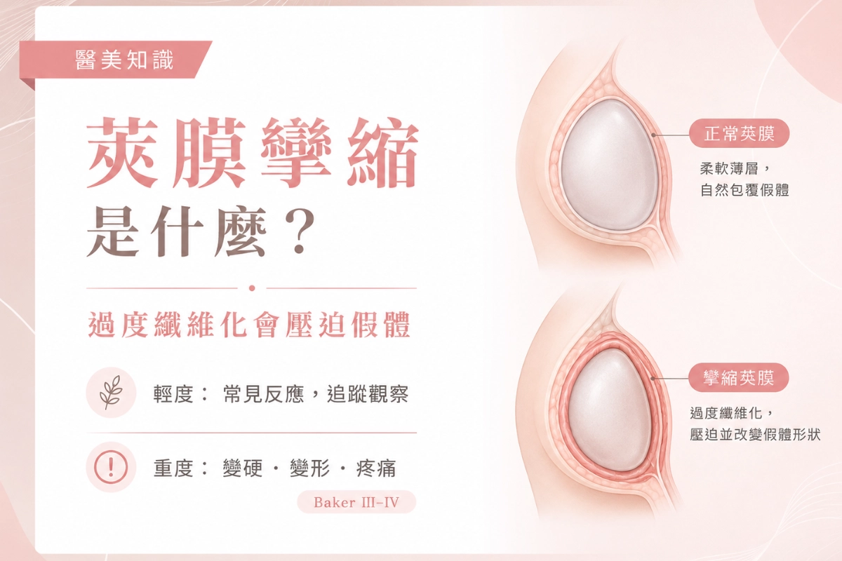 莢膜攣縮(Capsular Contracture)是什麼?