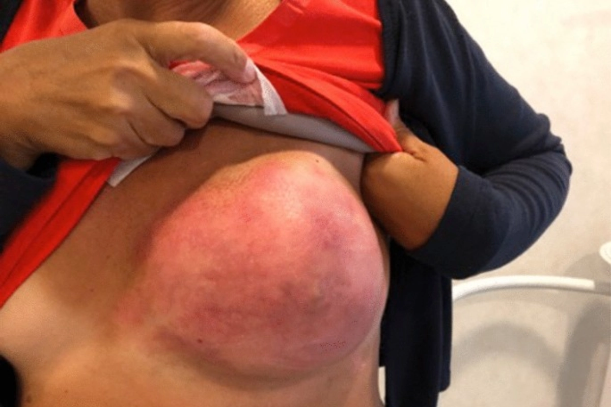 BIA-ALCL(乳房植入物相關間變性大細胞淋巴瘤)