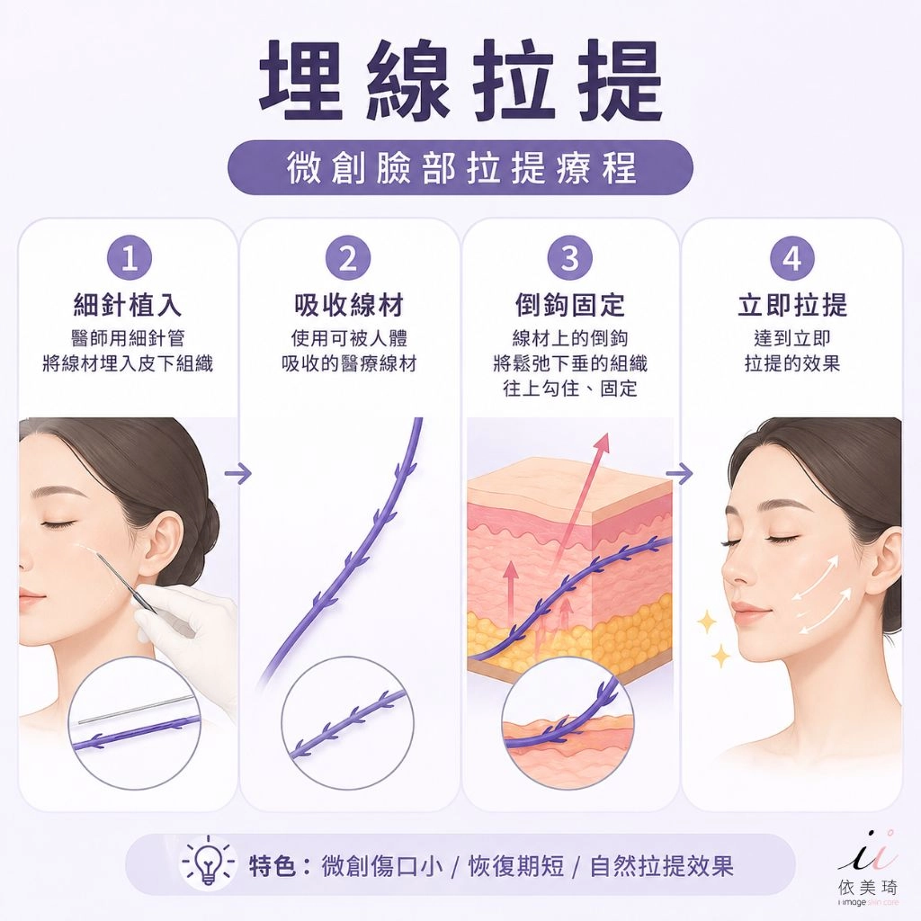 埋線拉提是一種微創的臉部拉提療程，醫師用細針管把可被人體吸收的醫療線材埋進皮下組織，靠線材上的倒鉤把鬆弛下垂的組織往上勾住、固定，達到立即拉提的效果。
