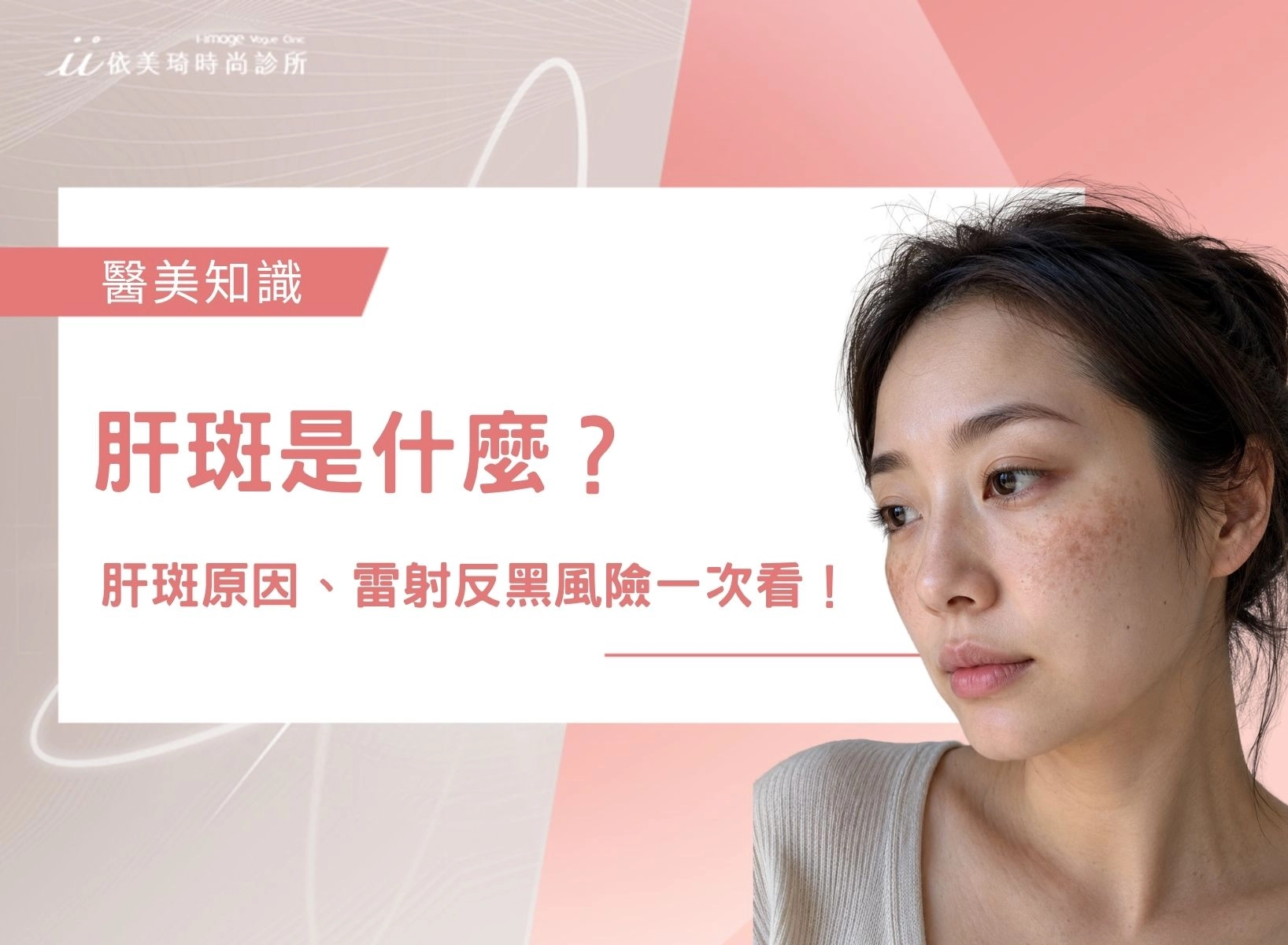 【2026】肝斑是什麼？肝斑如何去除？肝斑原因、雷射反黑風險一次看！