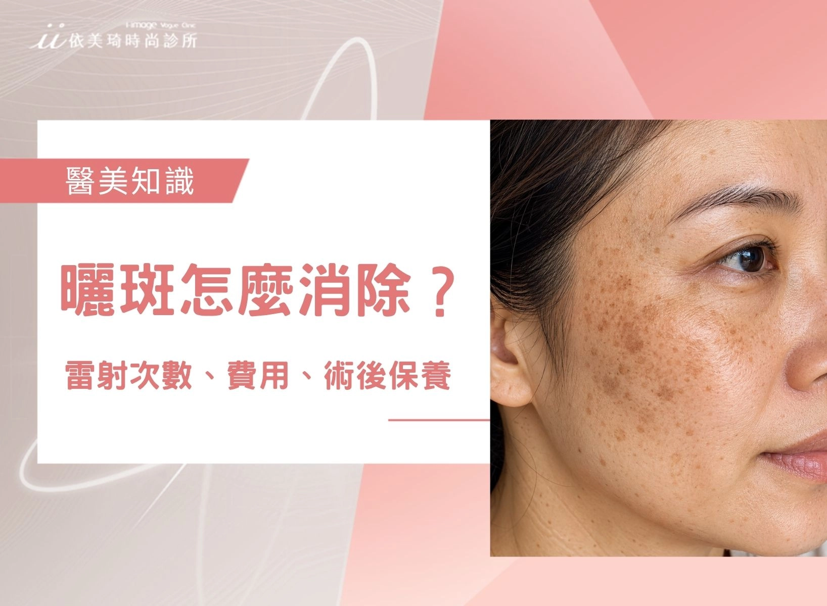 曬斑會消失嗎？曬斑怎麼消除？雷射次數、費用、術後保養一次看！