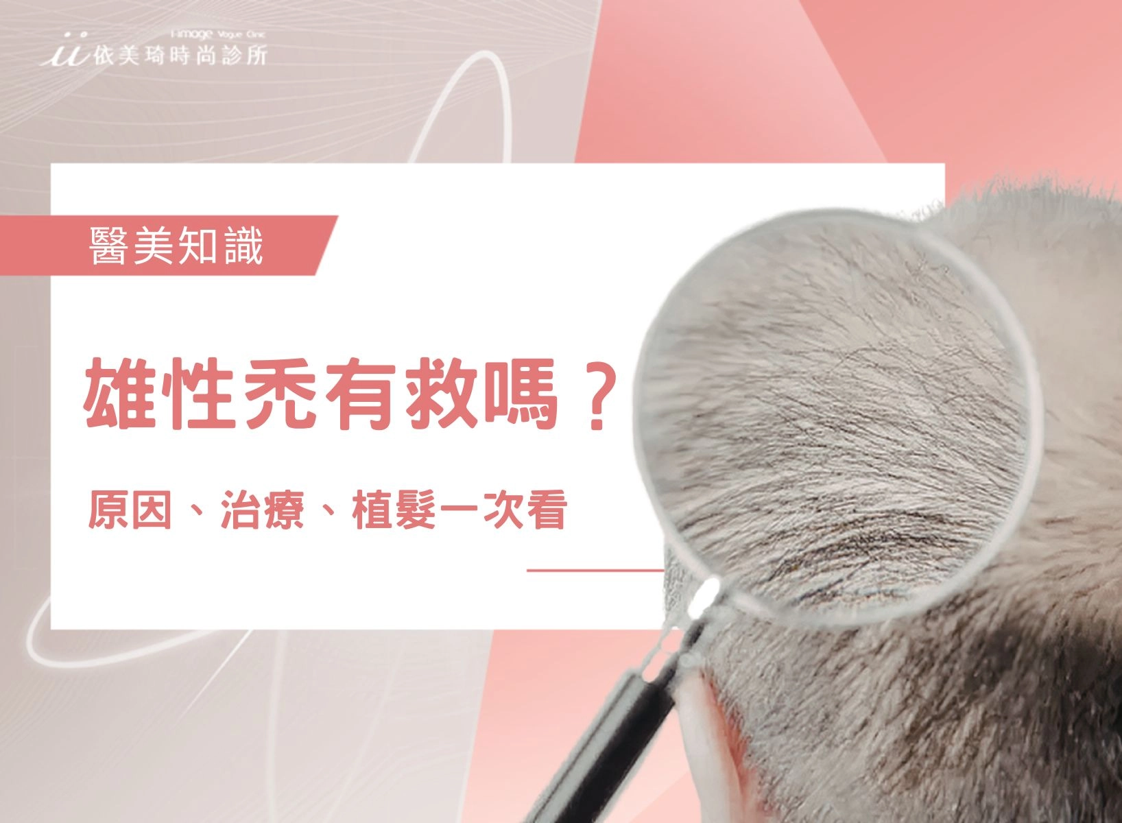 雄性禿有救嗎？女生也會雄性禿嗎？雄性禿原因、治療、植髮一次看！
