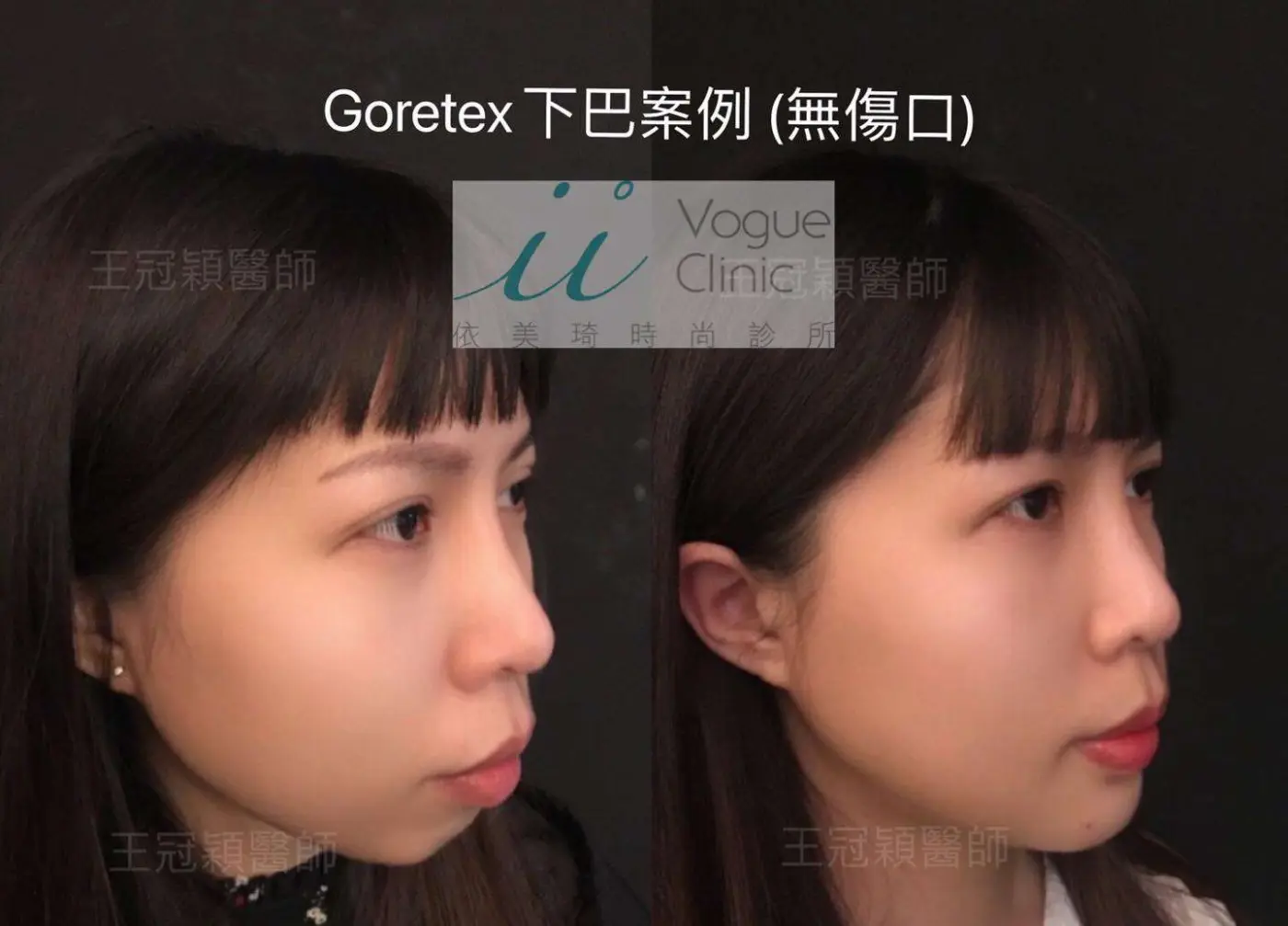 下巴手術成功案例